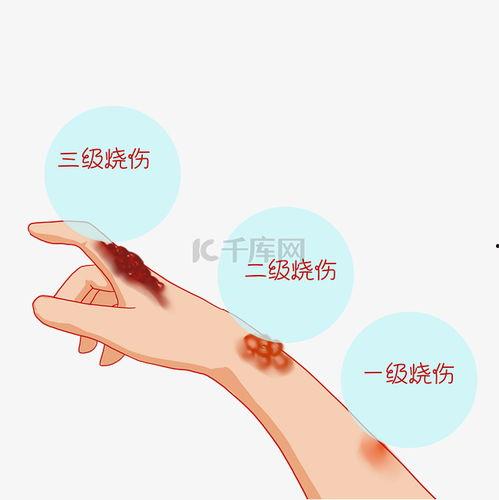 手烫伤的图片,手部烫伤紧急处理与康复指南